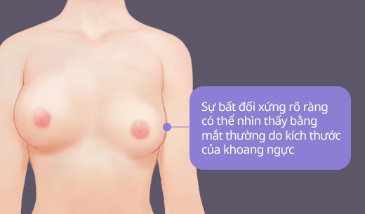 Sự bất đối xứng rõ ràng 
								có thể nhìn thấy bằng 
								mắt thường do kích thước 
								của khoang ngực