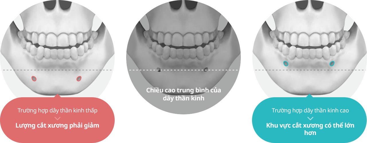 Trường hợp dây thần kinh thấp - Lượng cắt xương phải giảm
				Chiều cao trung bình của dây thần kinh
				Trường hợp dây thần kinh cao - Khu vực cắt xương có thể lớn hơn