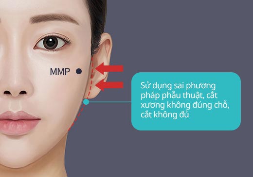 Sử dụng sai phương pháp phẫu thuật, cắt xương không đúng chỗ, cắt không đủ