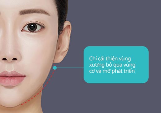 Chỉ cải thiện vùng xương bỏ qua vùng cơ và mỡ phát triển