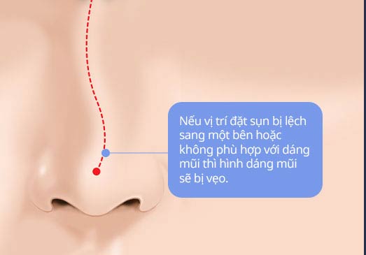 Nếu vị trí đặt sụn bị lệch sang một bên hoặc không phù hợp với dáng mũi thì hình dáng mũi sẽ bị vẹo.