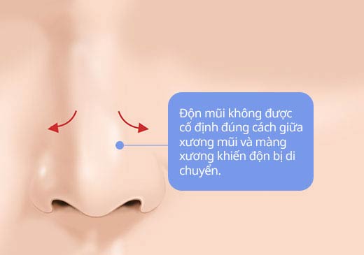Độn mũi không được cố định đúng cách giữa xương mũi và màng xương khiến độn bị di chuyển.