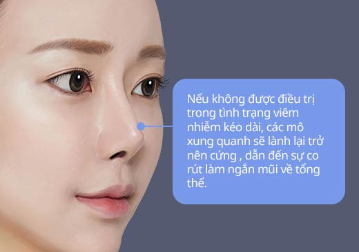 Nếu không được điều trị trong tình trạng viêm nhiễm kéo dài, các mô xung quanh sẽ lành lại trở nên cứng , dẫn đến sự co rút làm ngắn mũi về tổng thể.